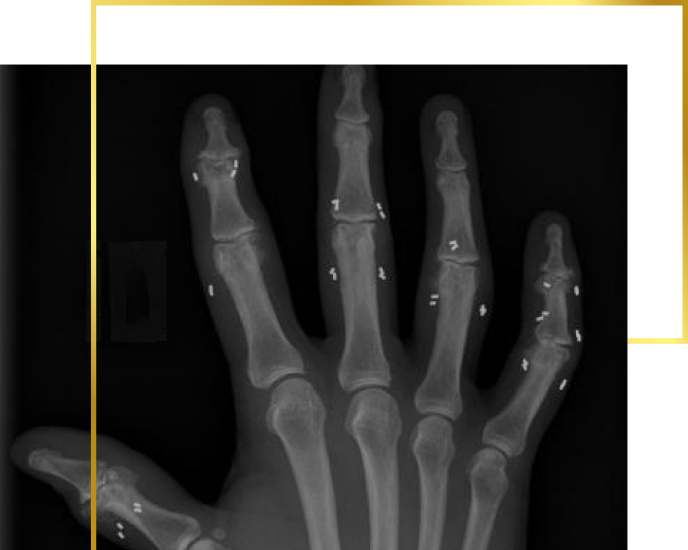 Gold implants in finger joints, gold therapy, pain therapy