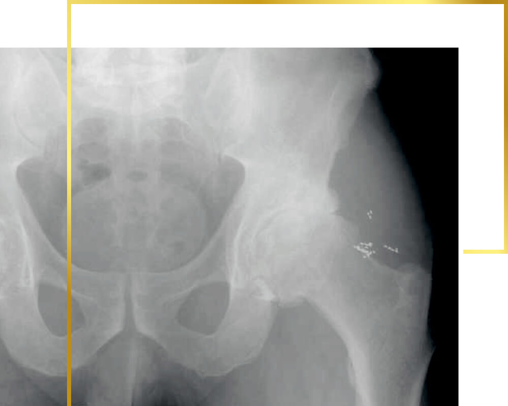 Gold implants in hip joints, gold therapy, pain therapy
