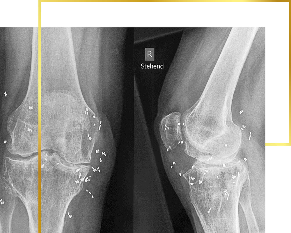 Gold implants in knee joints, gold therapy, pain therapy