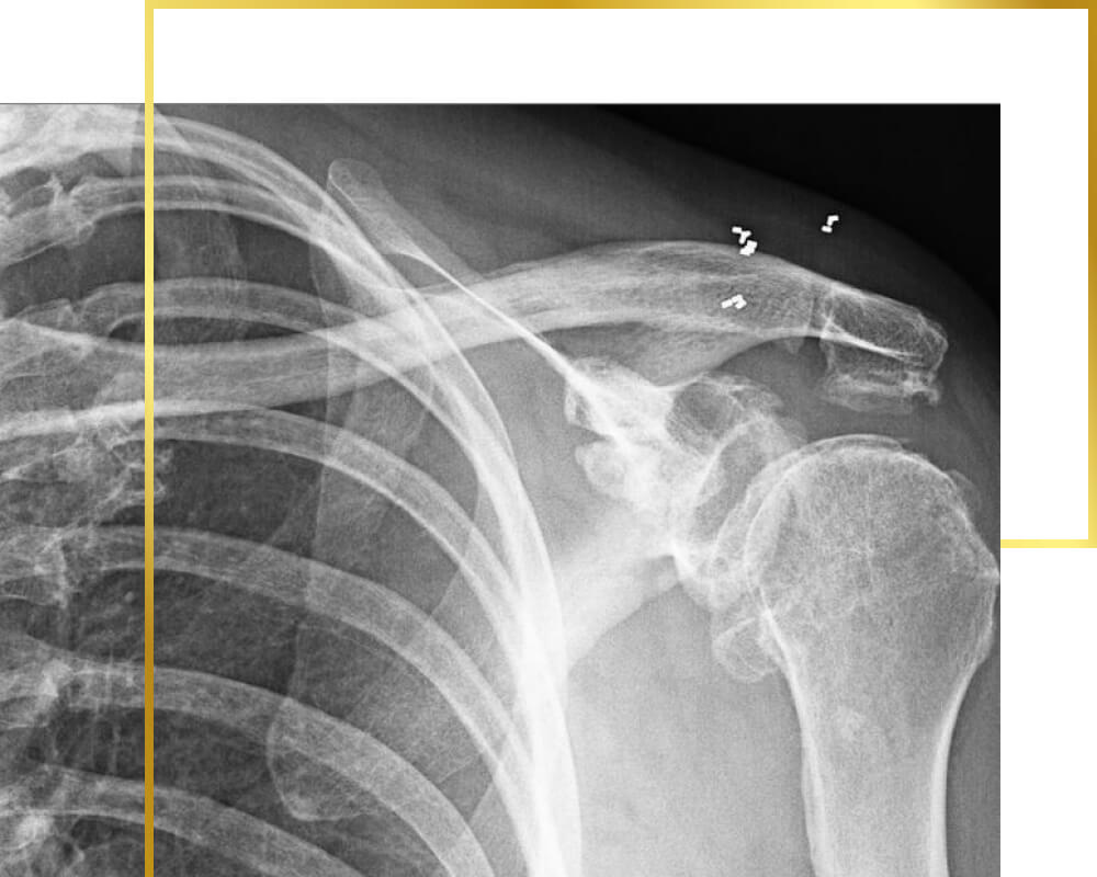 Gold implants in shoulder joints, gold therapy, pain therapy