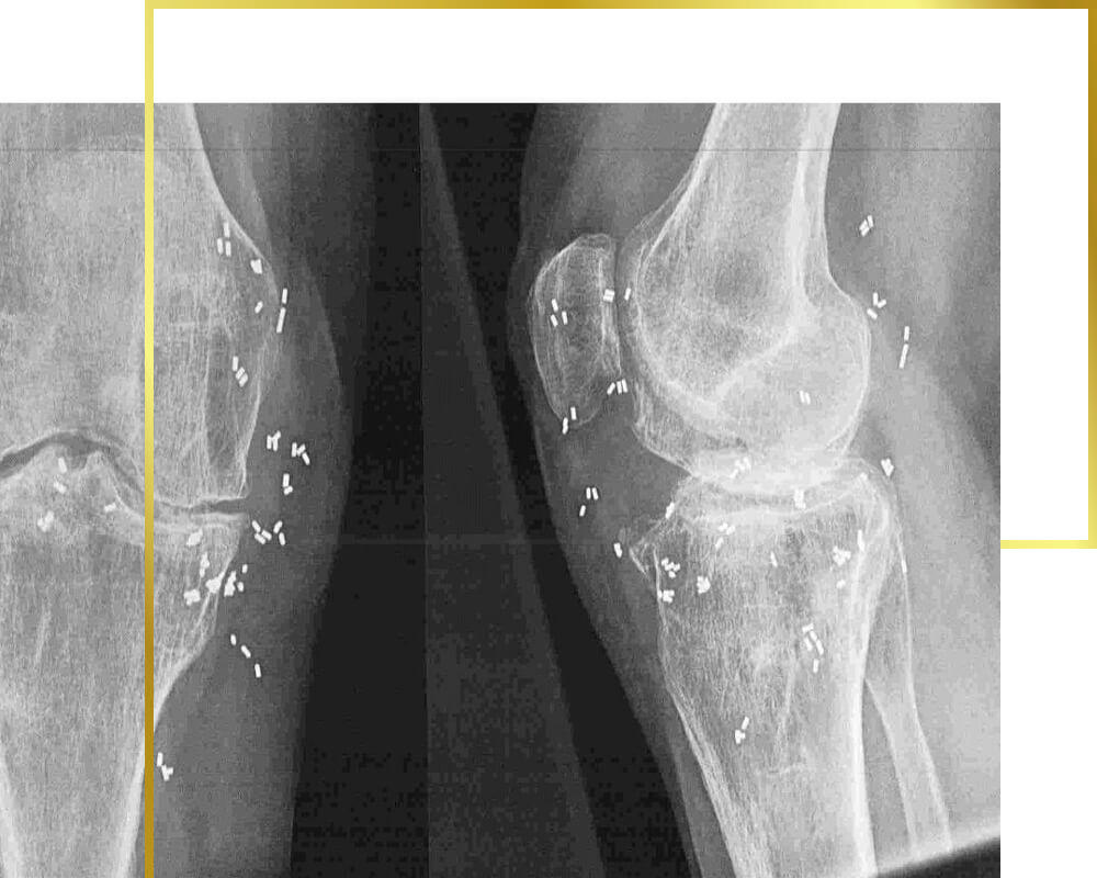 Goldimplantation Art der Behandlung Röntgenbild