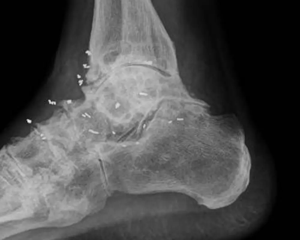 Gold implantation on the ankle joint for joint pain